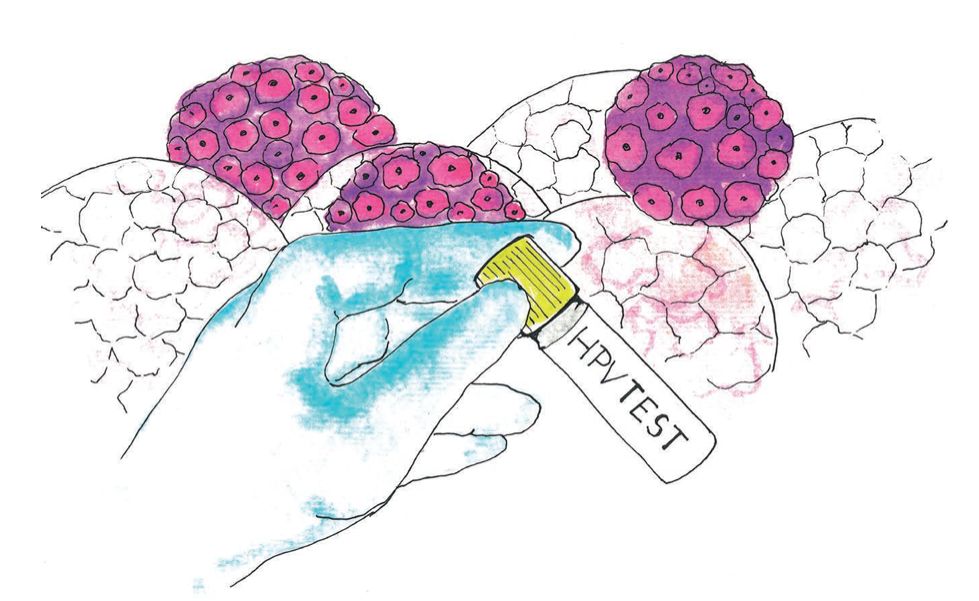 Ingyenes HPV önmintavételi program Székesfehérváron